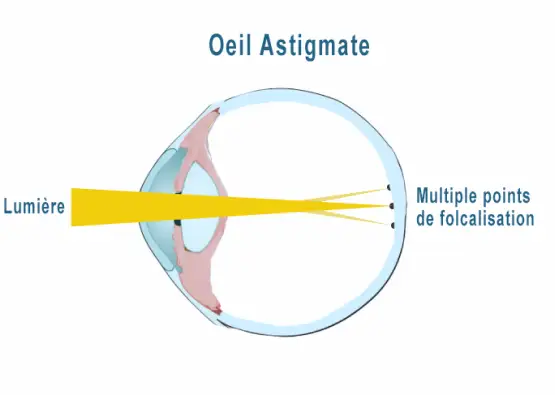 illustration-oeil-astigmate