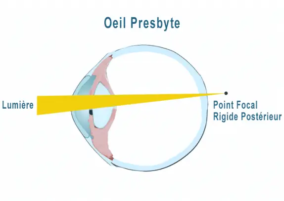 illustration-oeil-presbytie