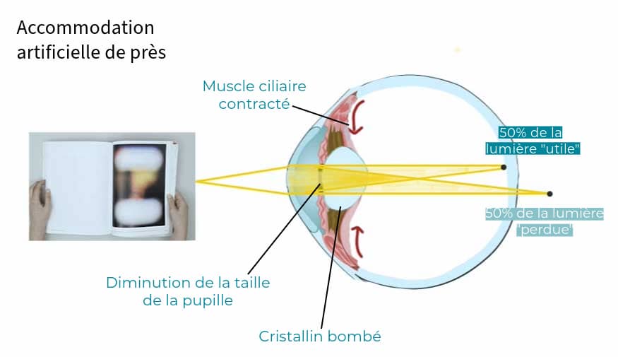 Multifocalité vision de pres presbytie