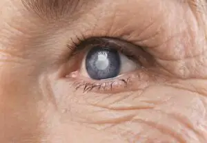 cicatrisation oeil femme avec cataracte