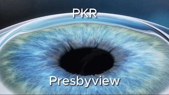 Operation laser technique PKR